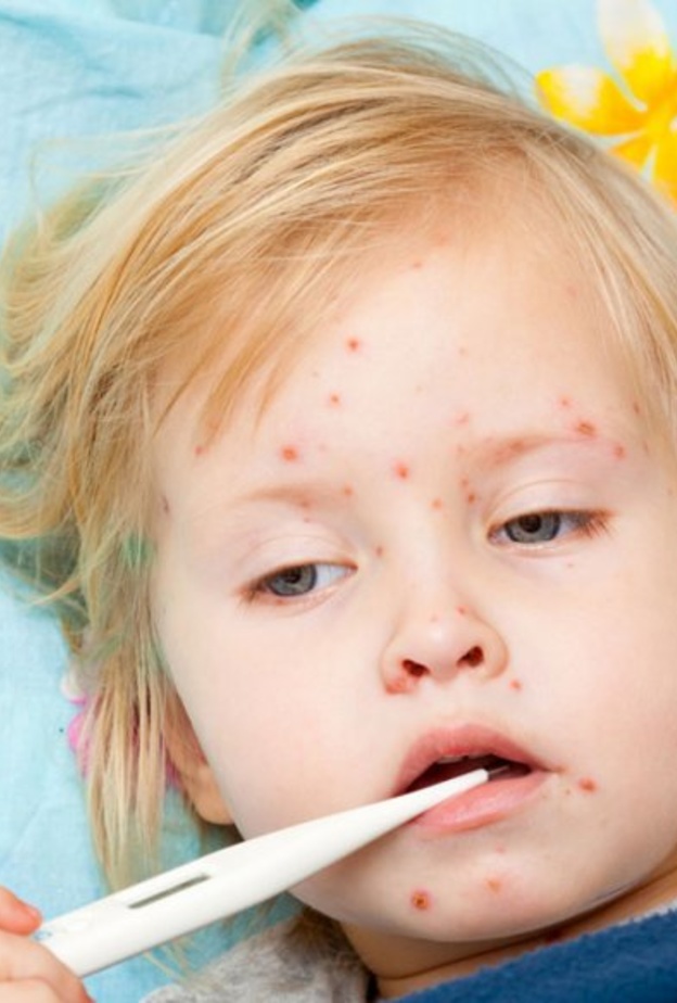 توضح وزارة الصحة اعراض الحصبة