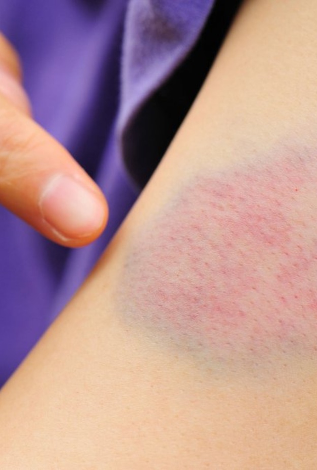 الكدمات من أبرز أعراض الهيموفيليا