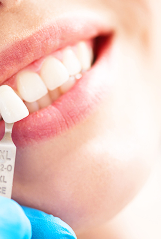عدسات الأسنان تخفي عيوب الأسنان