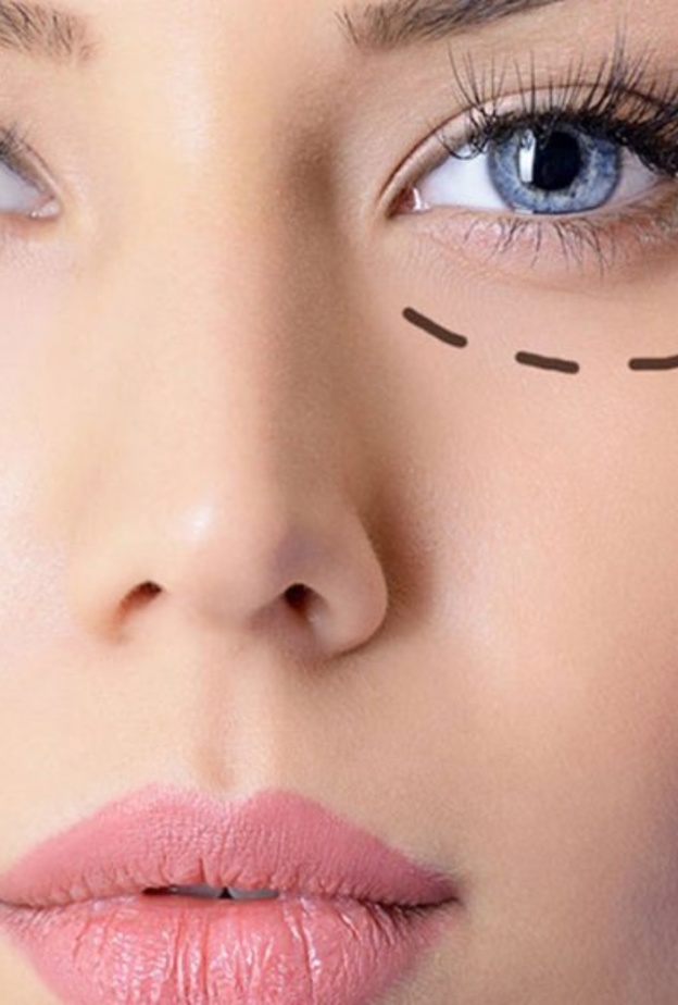 عملية شد الجفون تستمر من خمس إلى سبع سنوات على الأقل