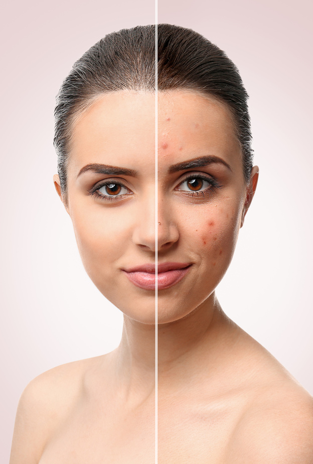 تخلصي من اثار البثور من خلال التقشير المنزلي