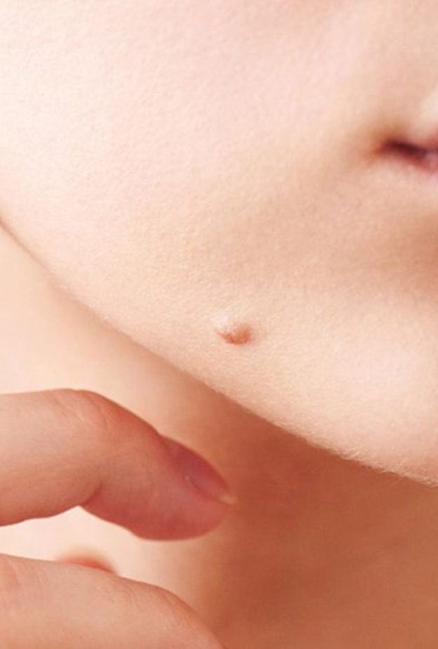 ظهور شامات جديدة غامقة من علامات السرطان