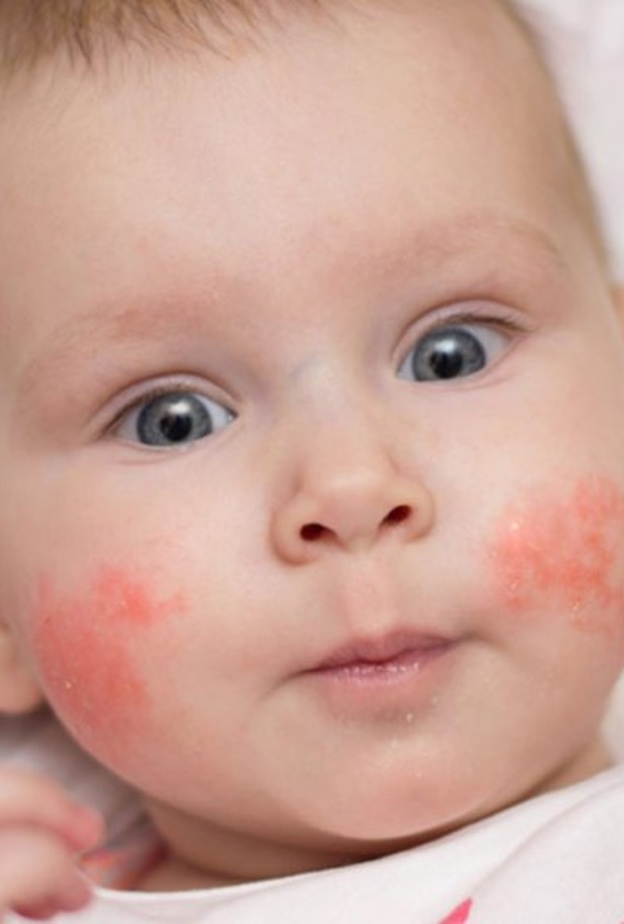  ما هي انواع حساسية الجلد عند الاطفال