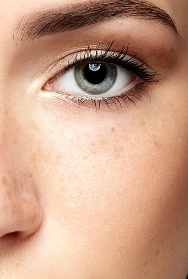 الجراحة الليزرية لإزالة النمش دائمة، لكن هذا لا يعني أن النمش لا يمكن أن تعود للظهور مرة أخرى