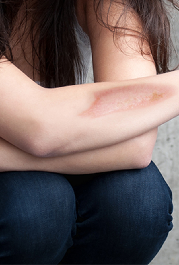 الليزر تقنية مهمة وفعّالة لإزالة الحروق عن الجسم