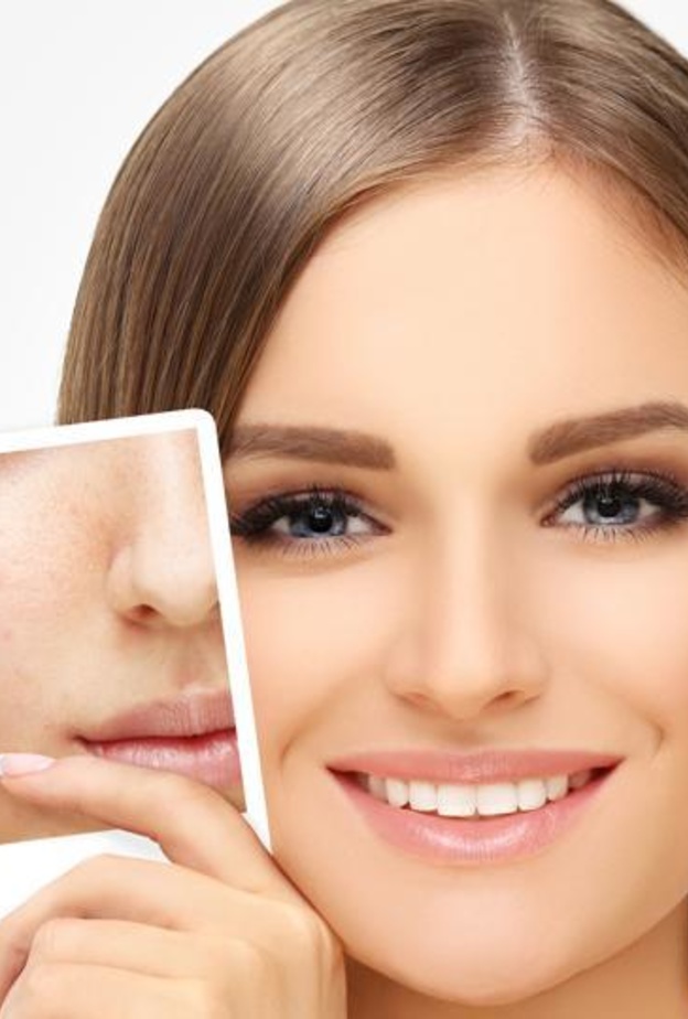 اخفاء حبوب الوجه بالمكياج