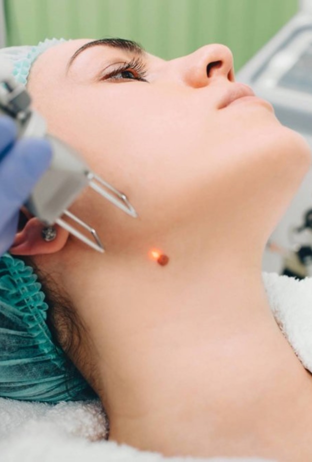  الليزر سيساعدك على التخلص من أي شامة في جسمك بطريقة سهلة وسريعة