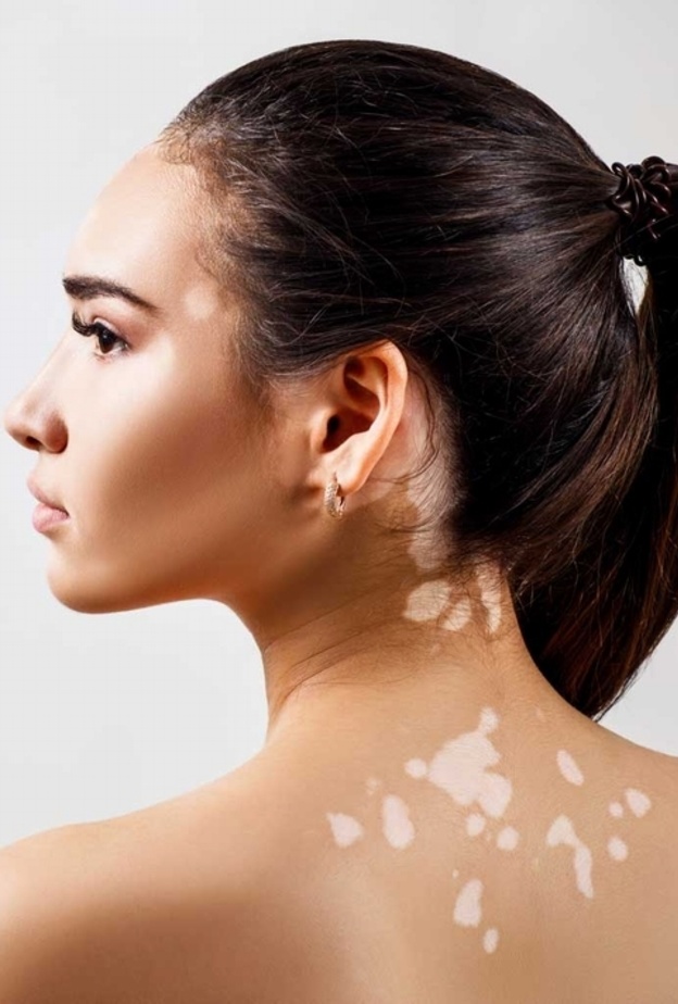 البهاق هو حالة جلدية مزمنة تؤدي إلى تلف مناطق الجلد