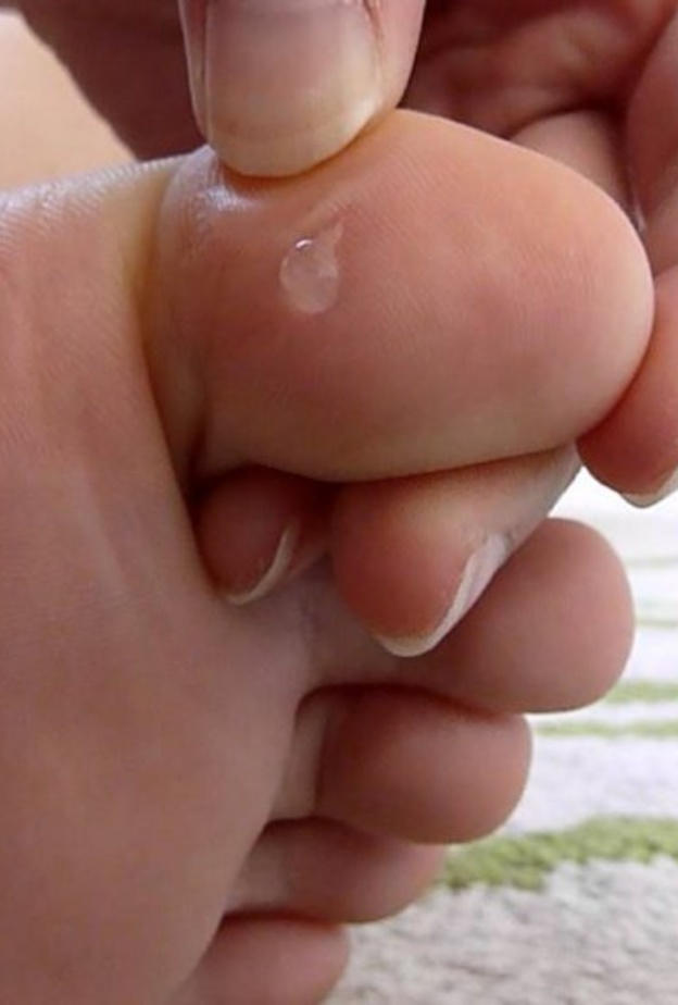  الفقاعات المائية على الجلد من أعراض جدري الماء