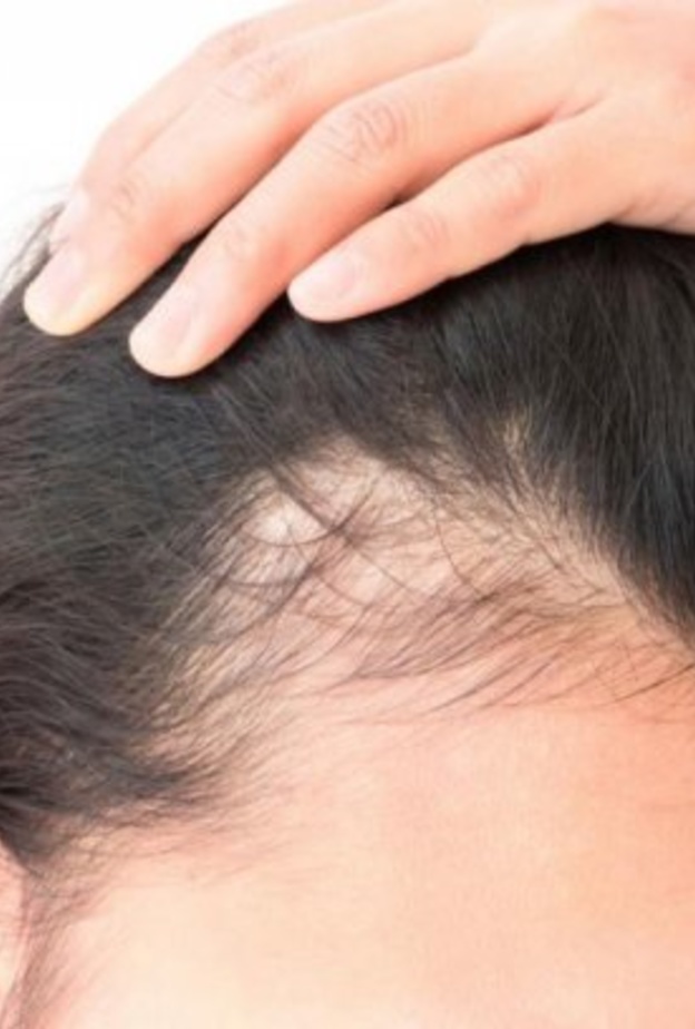 الثعلبة مرض مناعي يصيب النساء