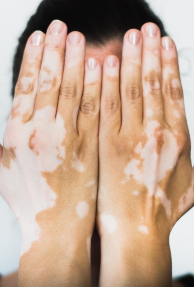 اعراض مرض البهاق اسبابه وطرق علاجه