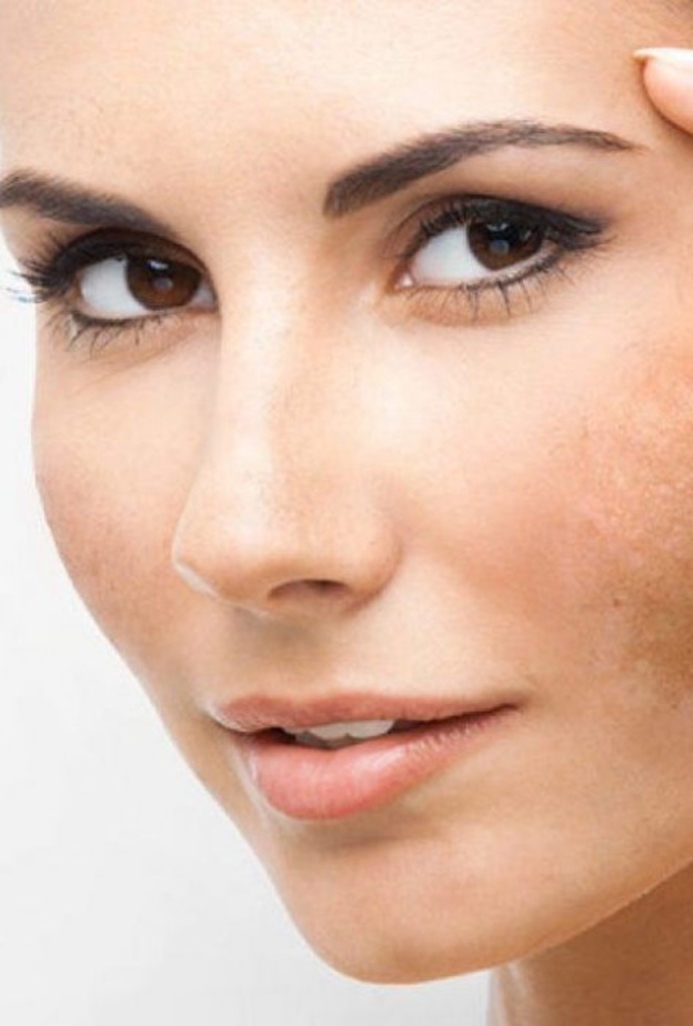 تعرفي على وصفات طبيعية لازالة كلف الوجه في يوم واحد