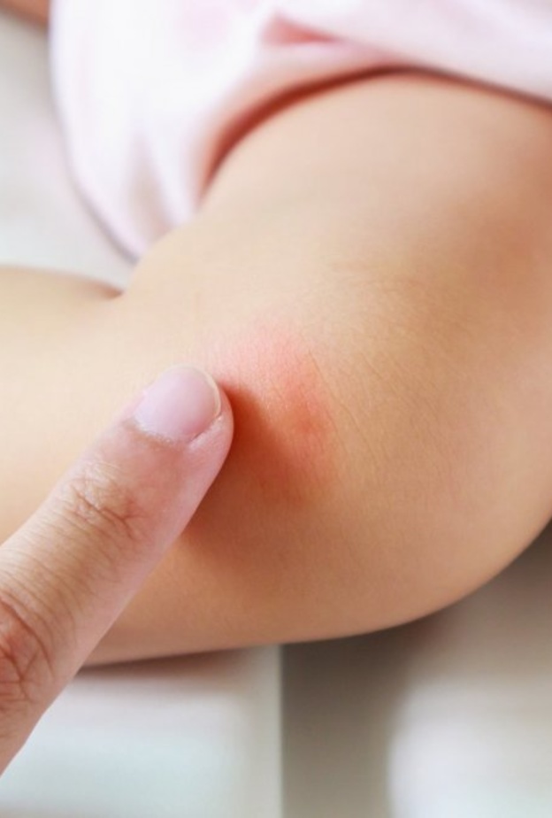 المكسرات يمكن أن تسبب حساسية الإرتكاريا