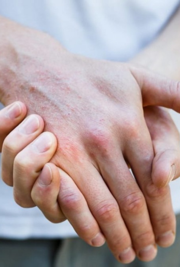  البهاق مرض جلدي يصعب الوقاية منه