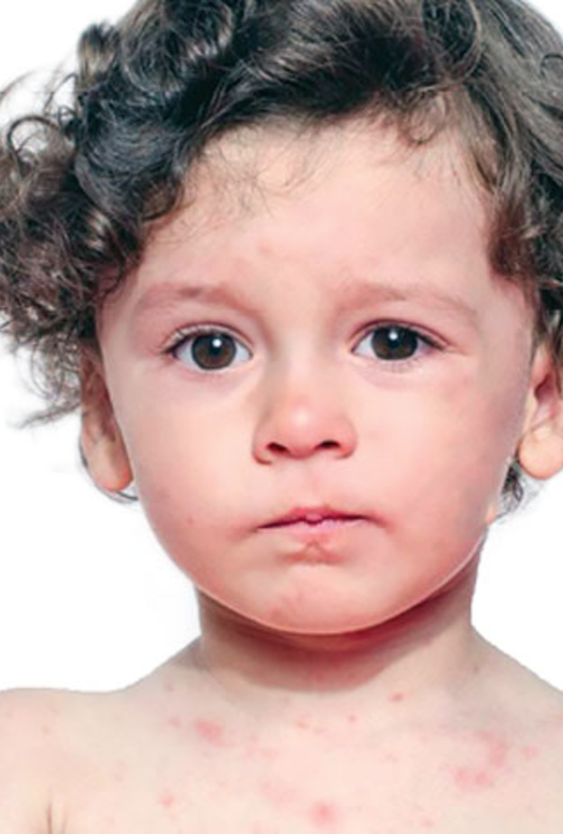 أهم اعراض الجدري المائي عند الاطفال ومخاطره