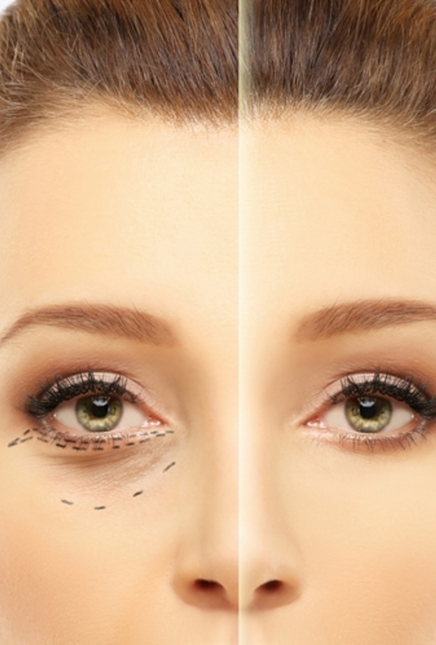  فوائد حقن الهيالورنيك للهالات السوداء