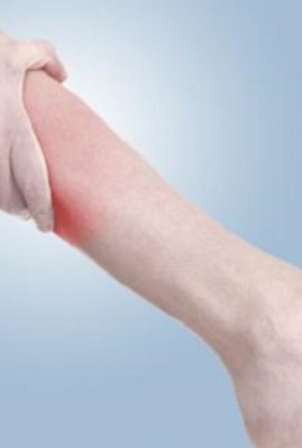 الدوالي عند النساء