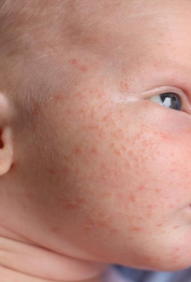 حبوب الوجه لدي الرضع