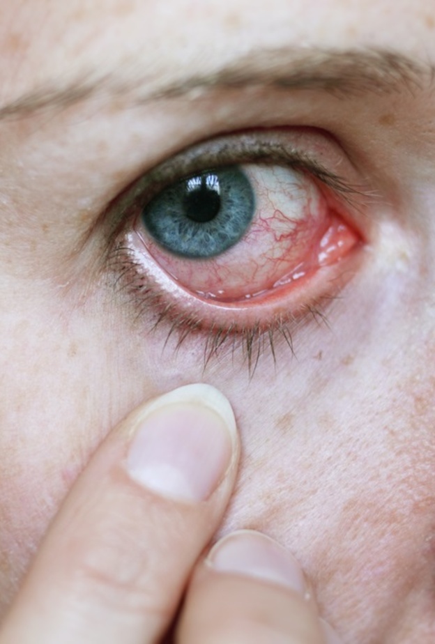 ما الفرق بين التهاب العين الفيروسي والبكتيري