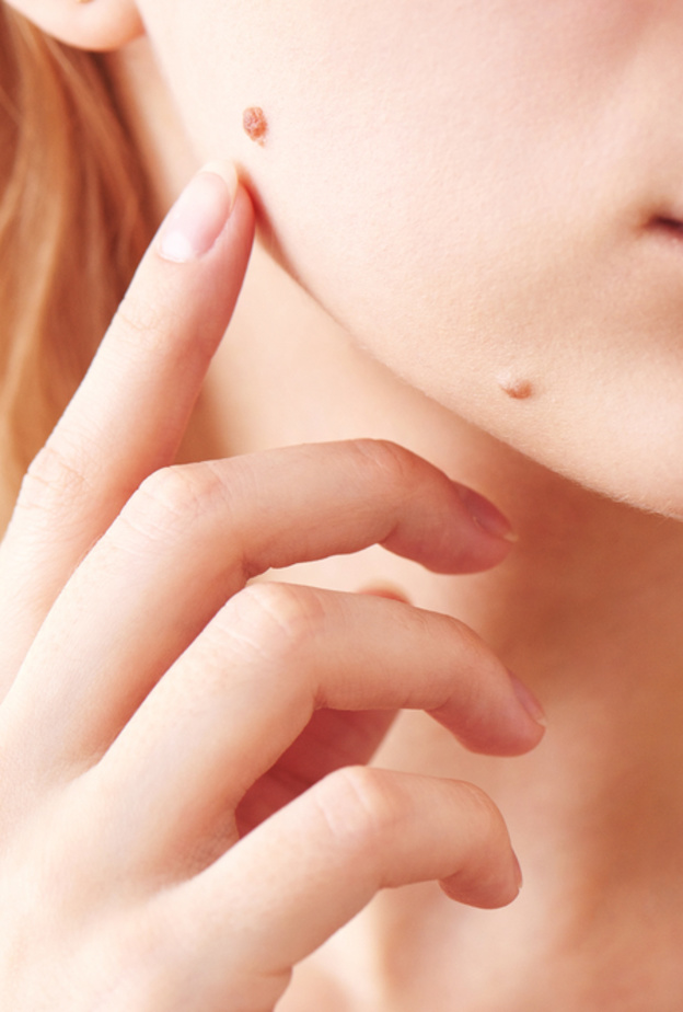 ازالة الشامة