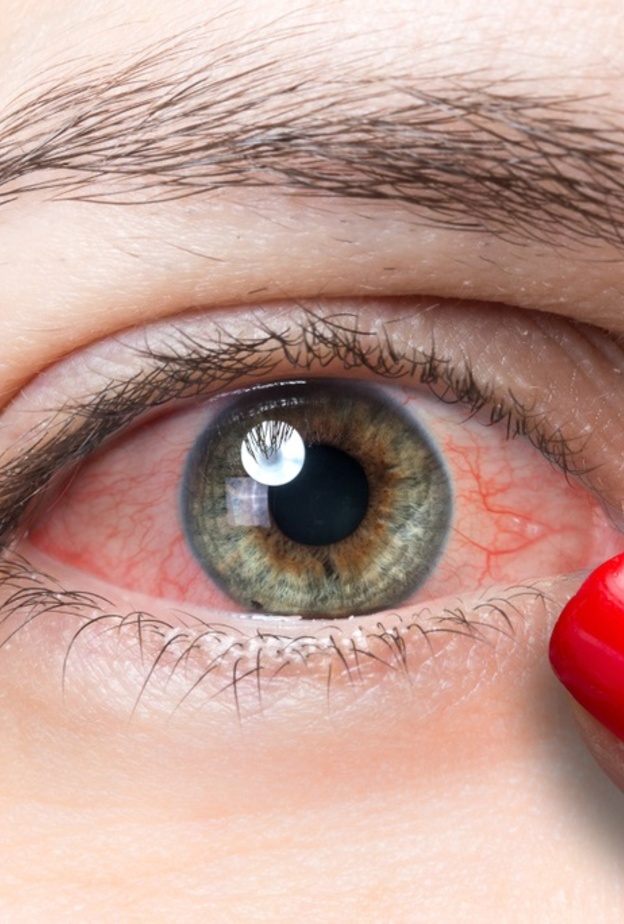 اسباب احمرار العين المتكرر وكيف يمكن تجنبه