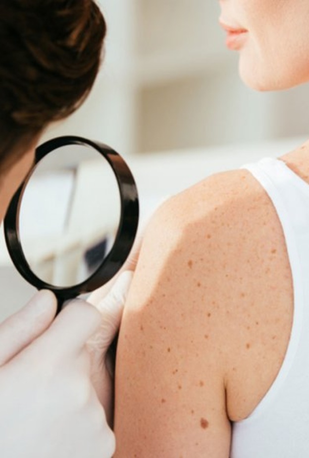 الشامات يمكن أن تتحول إلى سرطان في الجلد