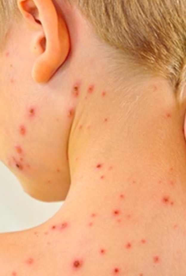 اعراض الحصبة الالمانية عند الاطفال وطرق علاجها