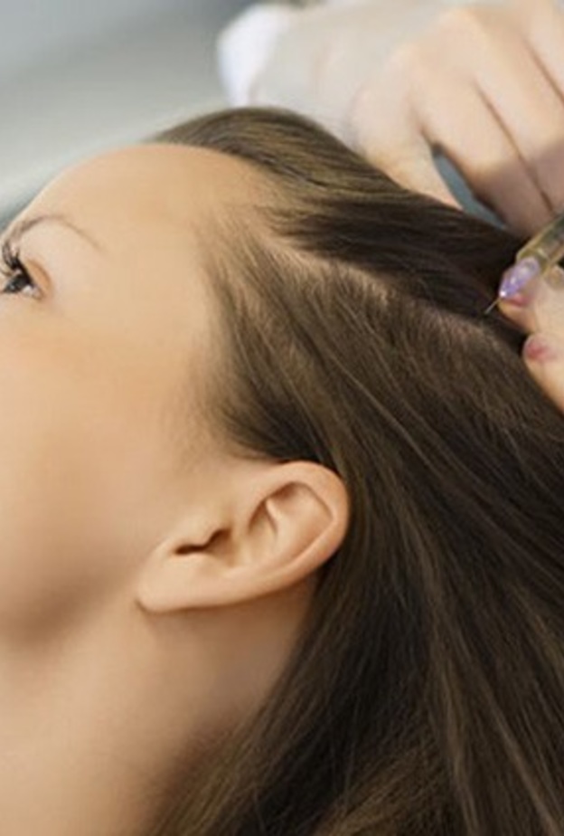 حقن البلازما الغنية بالصفائح الدموية قد تساعد في تقليل تساقط الشعر 