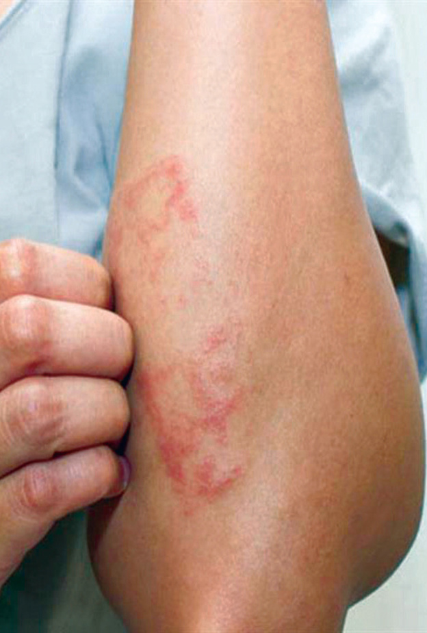  التقران السعفي يسبب بقع خشنة على الجلد