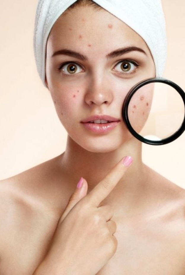 تخلصي من حب الشباب بالطرق الطبيعية في رمضان