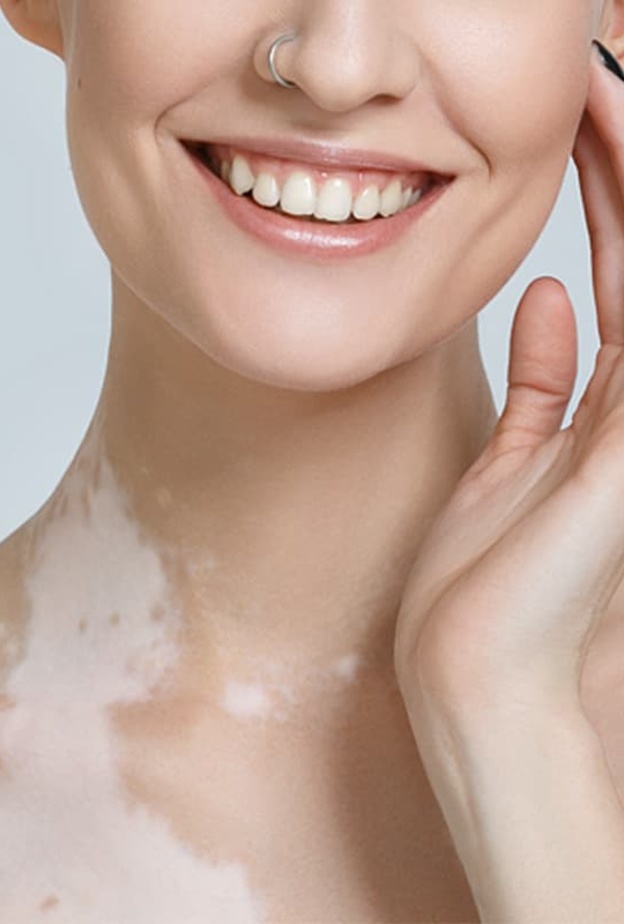 ماهي اعراض مرض البهاق الجلدي