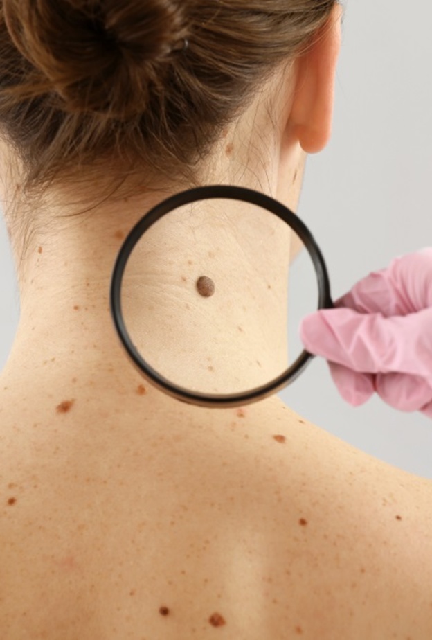 أهمية الفحص للكشف عن سرطان الجلد