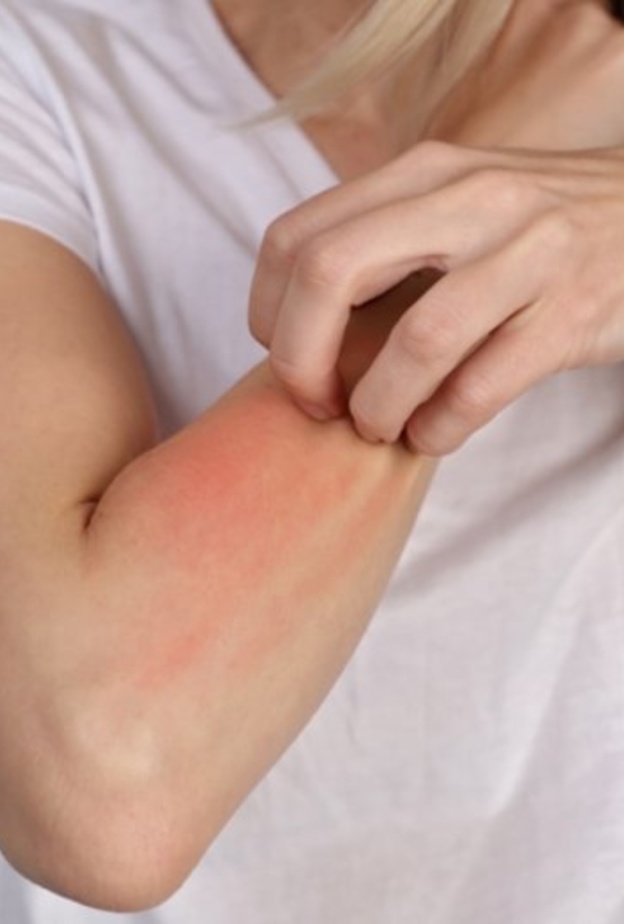 لدغات البعوض تسبب الحكة وإحمرار الجلد