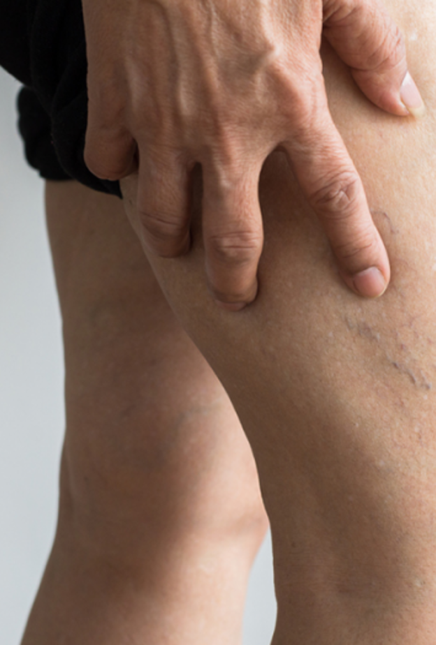 ماهو التخثر الوريدي العميق في الساق وما أسبابه