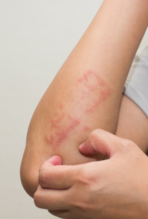  ماهي أعراض التهاب الجلد التماسي