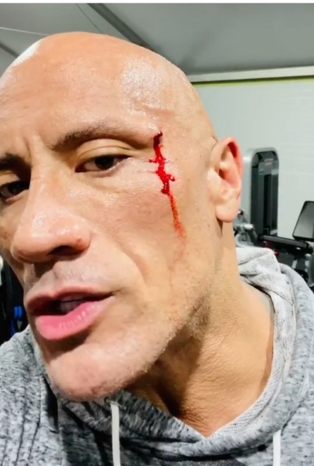 ذا روك يتعرض للاصابة في وجهه