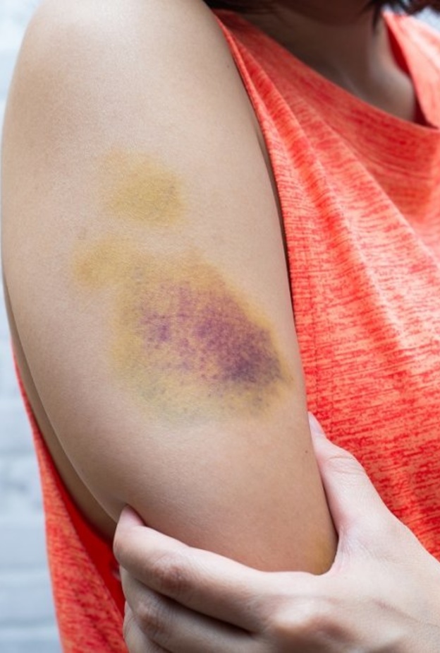  أسباب الكدمات على الجلد وطرق علاجها