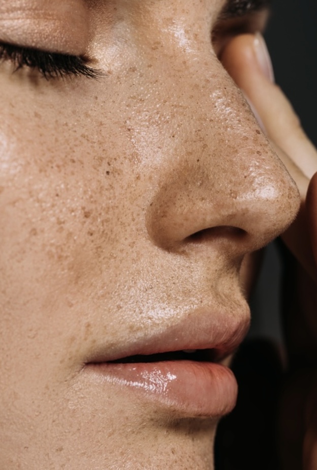  إزالة الكلف والنمش بالماسكات الطبيعية