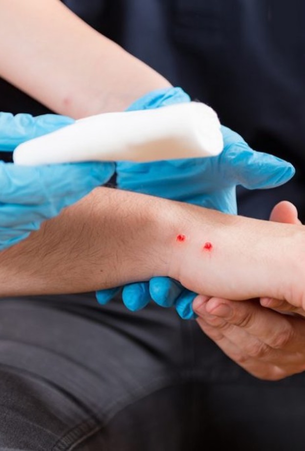 ماهي الاسعافات الاولية للدغة الافعى