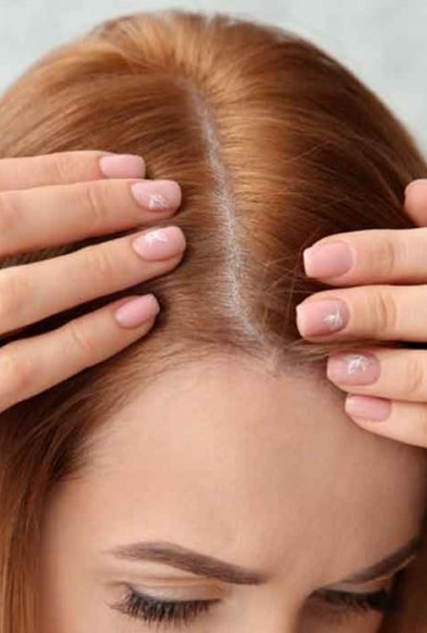 زراعة الشعر هو إجراء يتم فيه نقل الشعر إلى منطقة أصلع من الرأس لتكثيفها