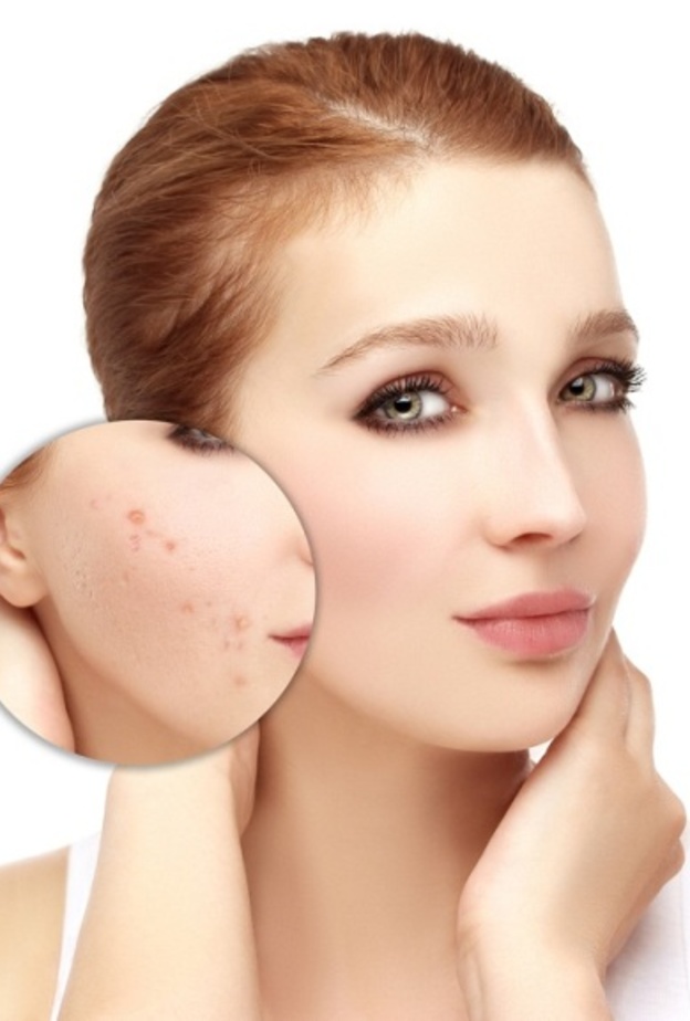  علاج حب الشباب بماسكات الطماطم ذات مفعول رائع