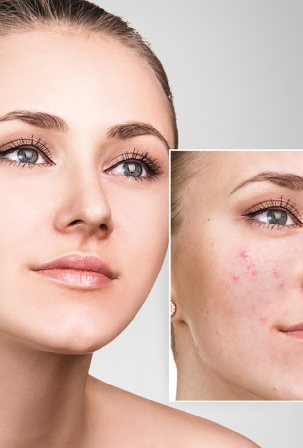 نصائح جمالية عند استخدام ماسك القرفة واللبن للتخلص من حب الشباب