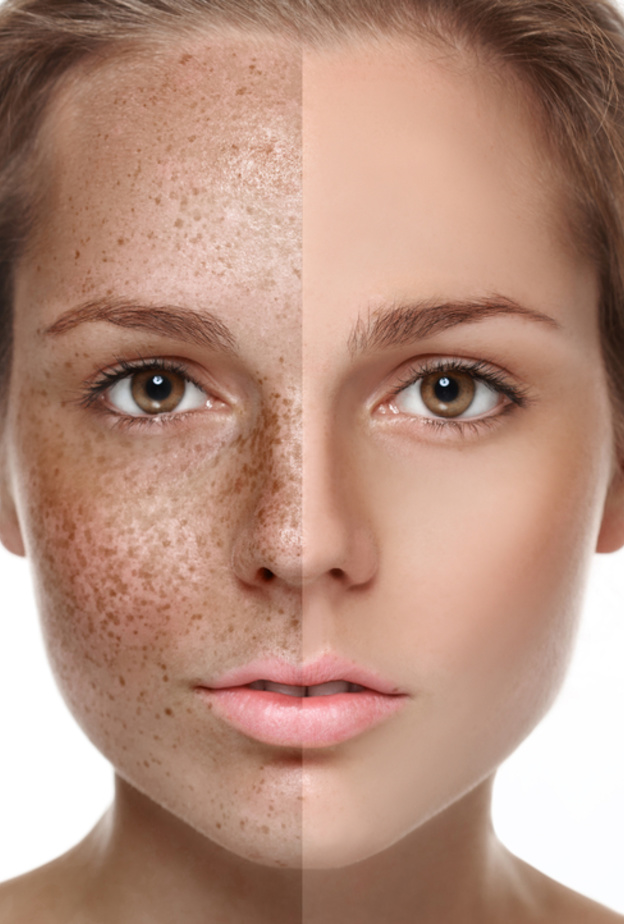  الوصفات المنزلية فعالة لإزالة النمش