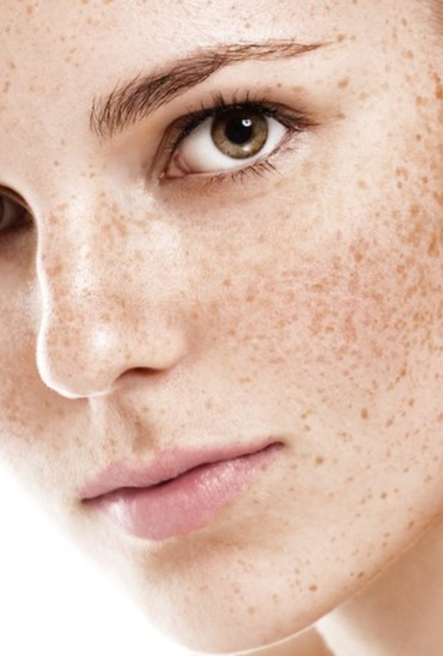  نصائح جمالية لعلاج النمش في الوجه