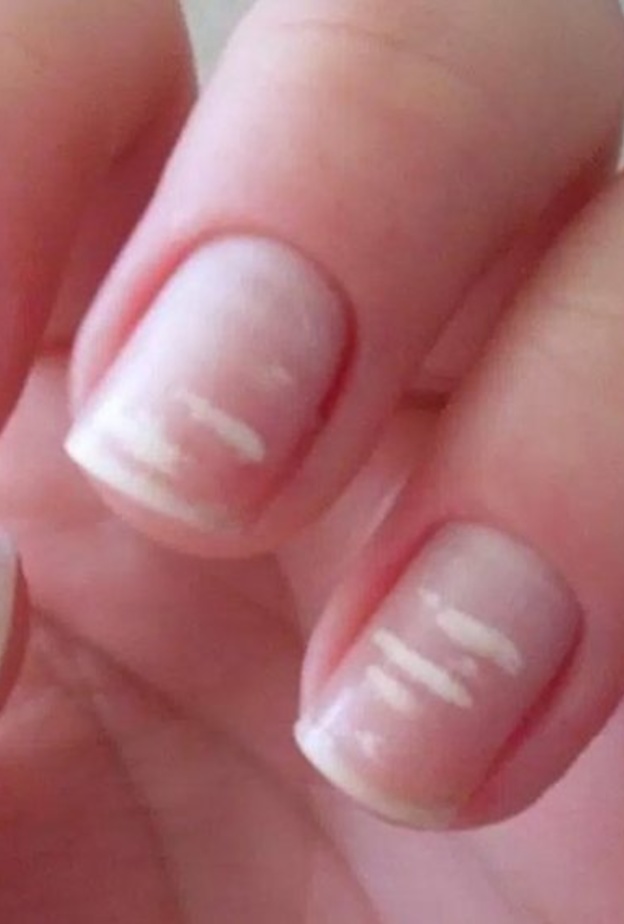 الخطوط البيضاء على الاظافر من اعراض كورونا