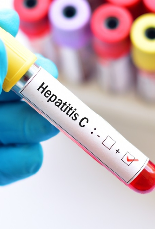 كيفية تشخيص التهاب الكبد الفيروسي وطرق علاجه