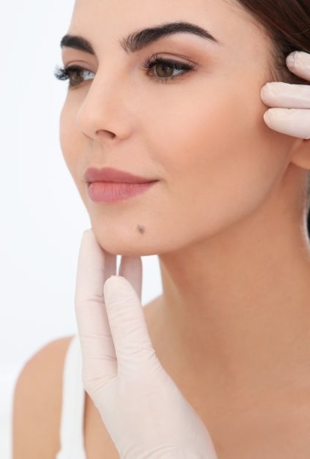 إزالة الشامات بالليزر تعد الطريقة الأسهل والأكثر استخداماً بين النساء