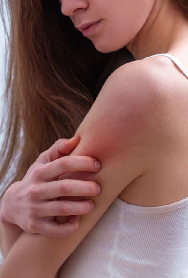  الصدفية من الامراض الجلدية المزمنة والشائعة