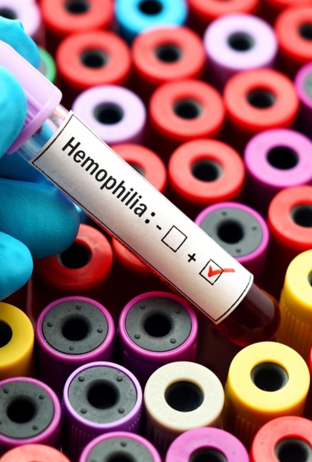 مرض الهيموفيليا الوراثي اسبابه وعلاجه وطرق الوقاية منه