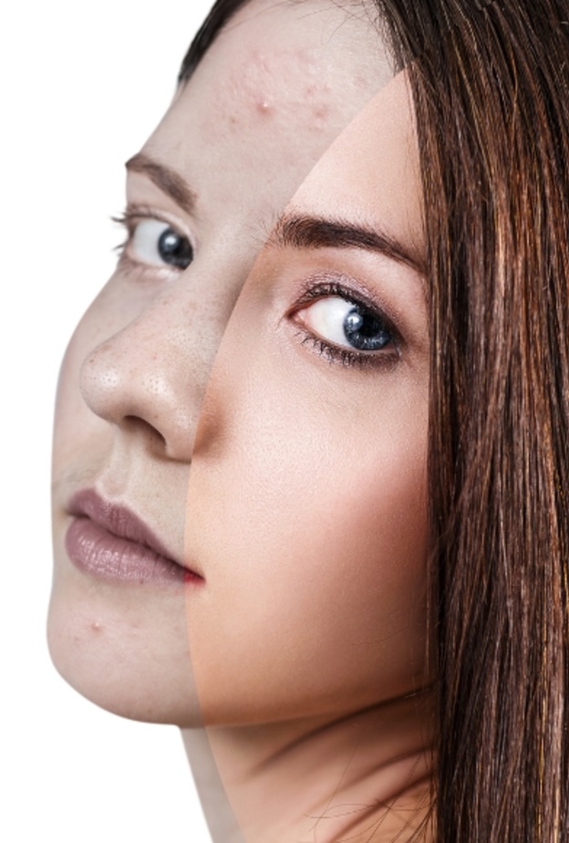 السدر لحب الشباب